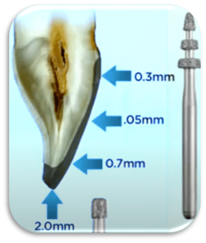 teeth reduction for veneers